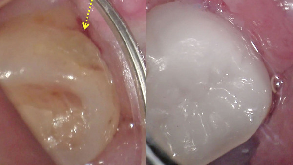手術用顕微鏡(マイクロスコープ)を使用して左下第二大臼歯のむし歯(虫歯)治療(セラミック治療編)