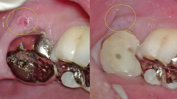 手術用顕微鏡(マイクロスコープ)を使用した左下奥歯の根管充填