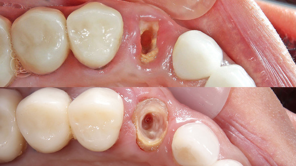 【歯を残す】右上の被せ物がはずれた方の治療(ファイバーコア編)