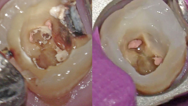 【根管治療】手術用顕微鏡(マイクロスコープ)を使用しての根管治療する前に隔壁作成