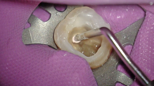 【根管治療】手術用顕微鏡(マイクロスコープ)を使用して右上奥歯の根管充填