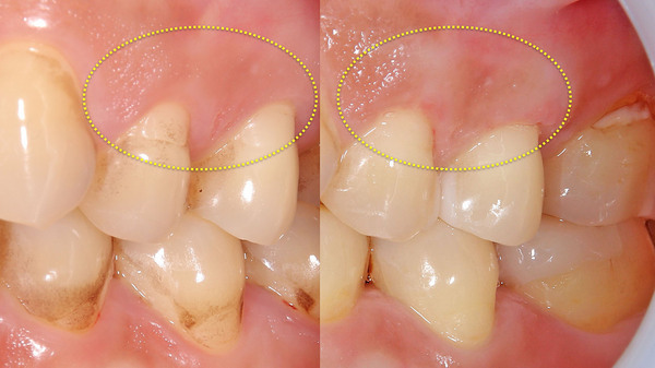 【歯がしみる】手術用顕微鏡(マイクロスコープ)を使用した左上の歯肉退縮の治療