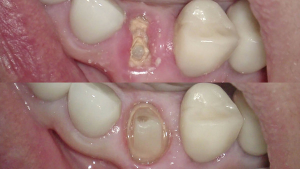 【歯を残す】右上の被せ物がはずれた方の治療(印象編)