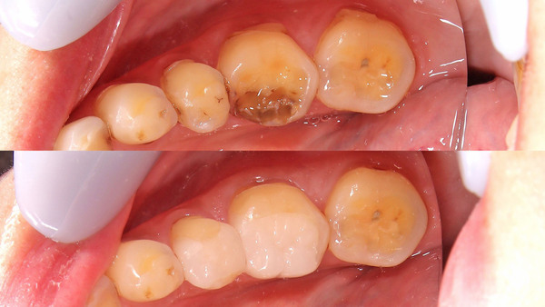 【歯を残す】長年放置していた右下奥歯のセラミック治療