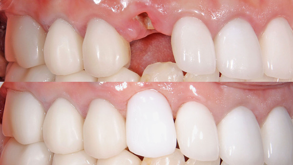 【歯を残す】右上の被せ物がはずれた方の治療(セラミック治療編)