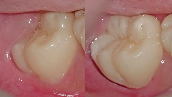 【親知らずの抜歯】手術用顕微鏡を使用した右下の親知らずの抜歯