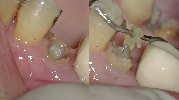 【歯を残す】右上第二小臼歯のむし歯治療(エクストリュージョン編)