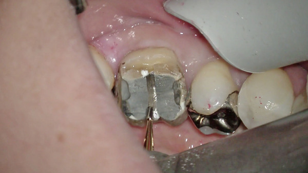 【根管治療】左下第一大臼歯のメタルコア除去について
