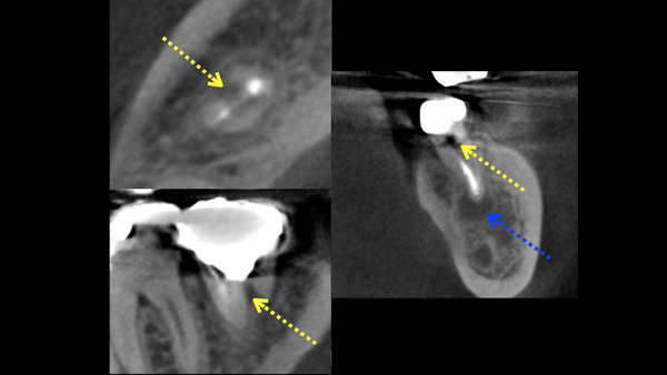 【根管治療】左下の奥歯の樋状根の治療について(画像診査編)