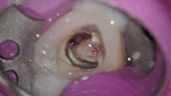 【根管治療】左下の奥歯の樋状根の治療について(根管治療編)