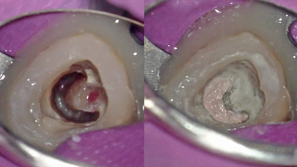【根管治療】左下の奥歯の根管充填とMTAセメントにてパーフォレーションリペア