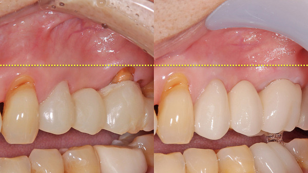 【歯周再生療法・補綴治療】左上の歯肉退縮と被せ物の治療