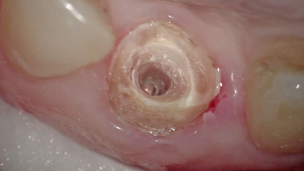 【根管治療】左上前歯のファイバーコア(土台)の除去