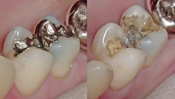 【セラミック治療】右上小臼歯の金属の下のむし歯（虫歯）治療 ①