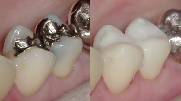 【セラミック治療】右上小臼歯の金属の下のむし歯（虫歯）治療 ②