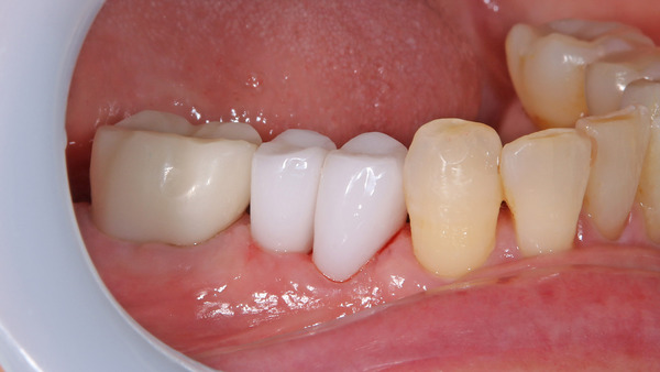 【歯を残す】被せものが脱離した右下小臼歯のエクストリュージョン＋セラミック治療