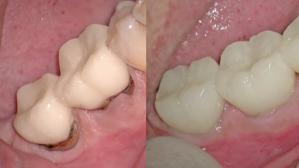 【歯を残す】右下の被せ物の下がむし歯(白い被せ物編)
