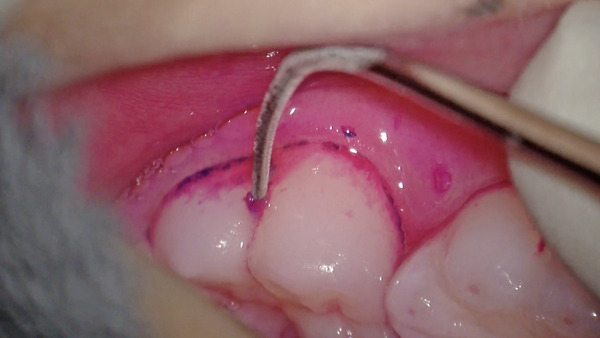 【小児歯科・予防歯科】8歳のお子さんのむし歯(虫歯)予防