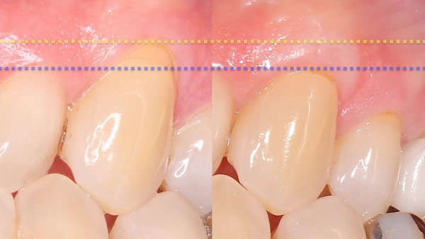 【歯肉退縮・歯周組織再生】左上犬歯の歯肉が下がり知覚過敏症状がある方の治療