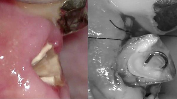 【歯を残す】左上前歯の被せ物が脱離(歯冠長延長術編)