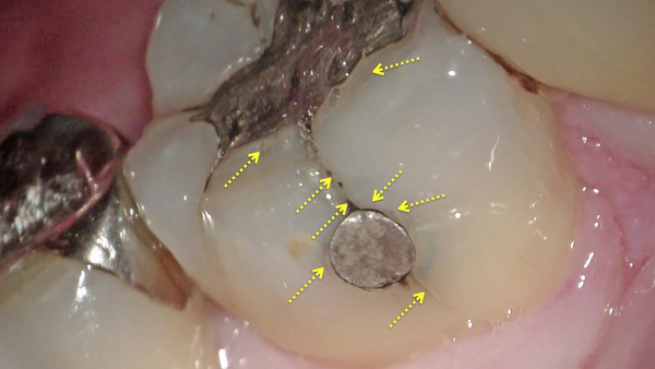 【セラミック治療・むし歯(虫歯)治療】昔治療した右下奥歯の金属を除去すると…