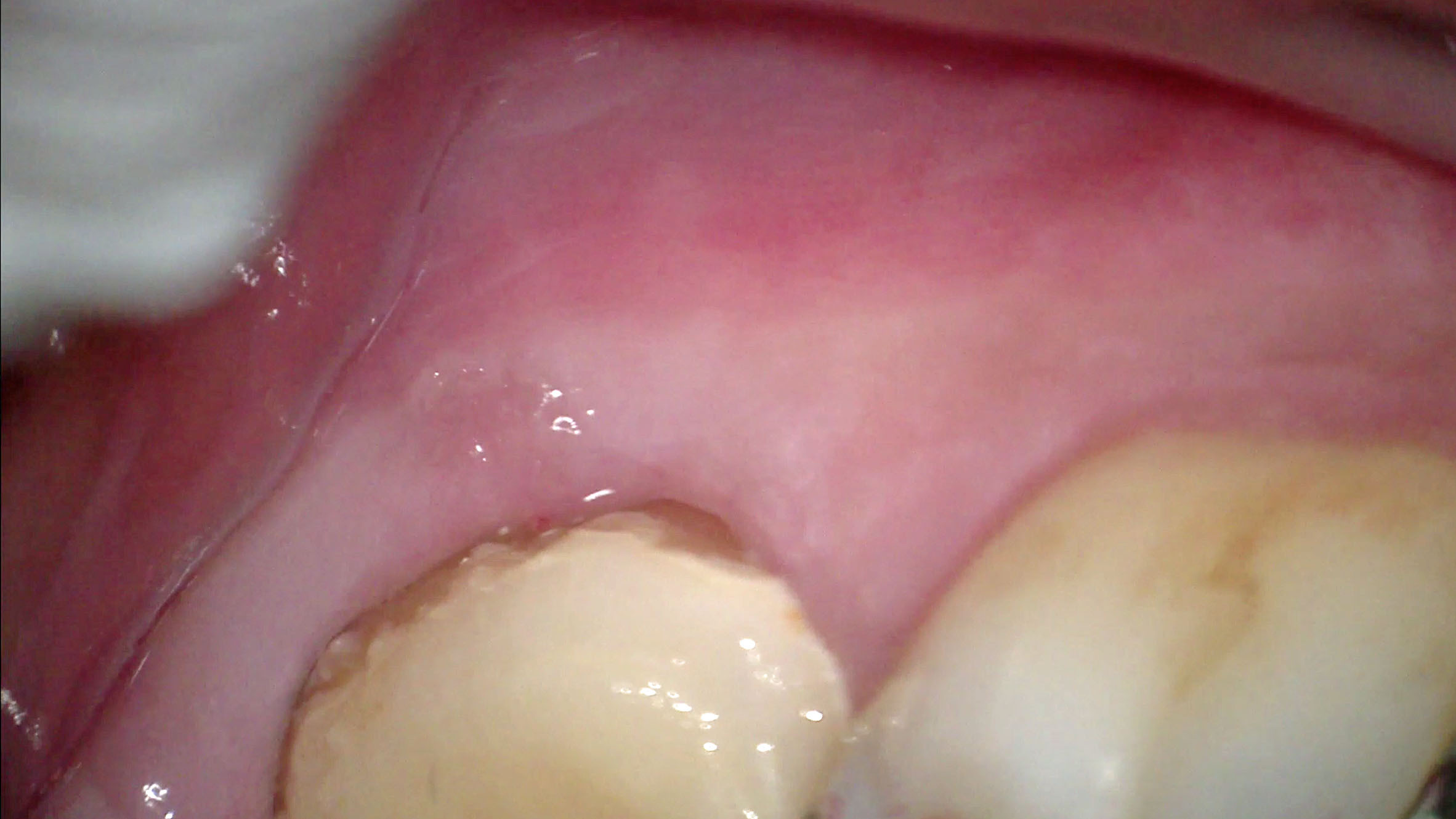 奥歯 の 腫れ