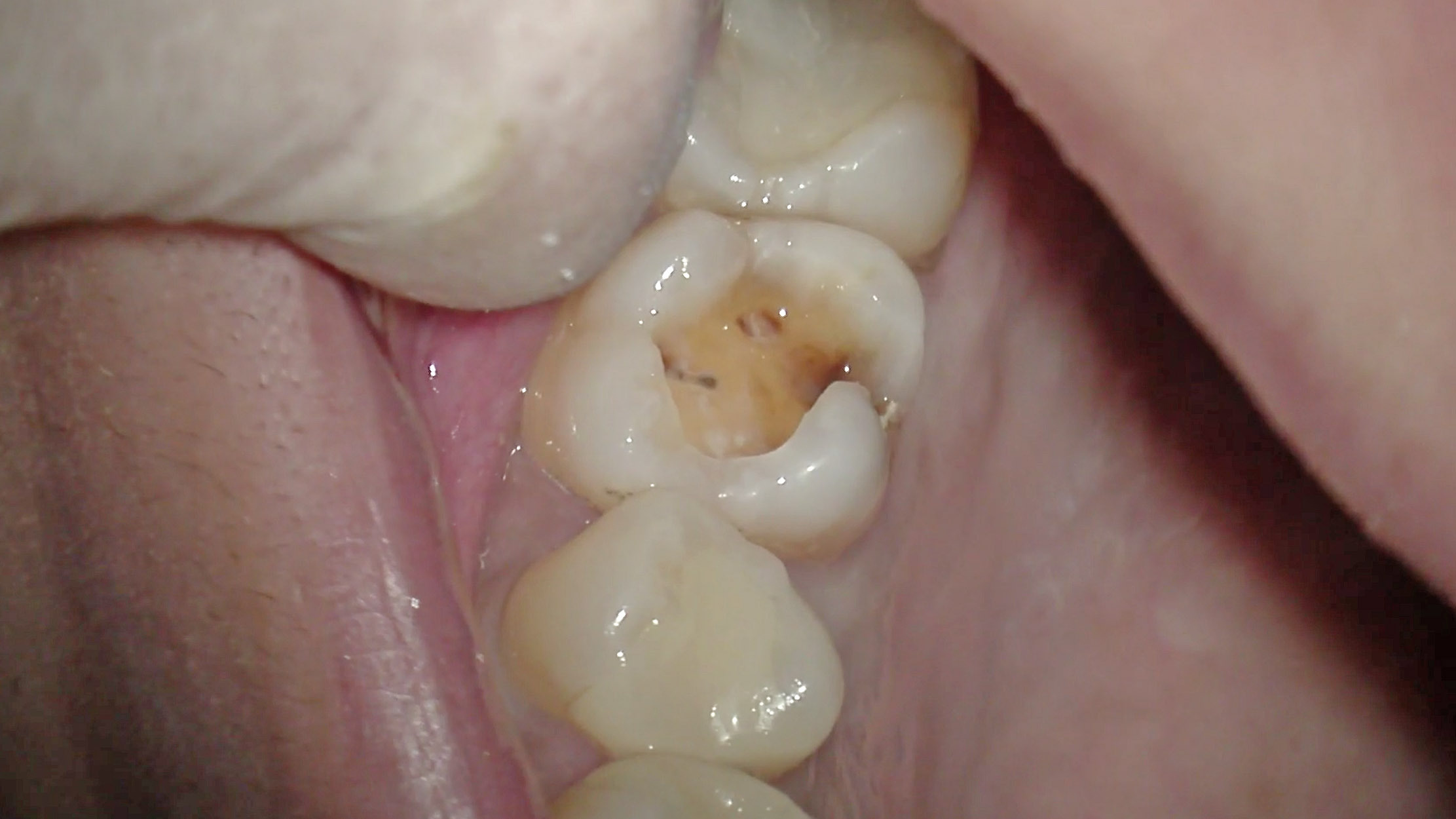 歯 が 欠け た 虫歯